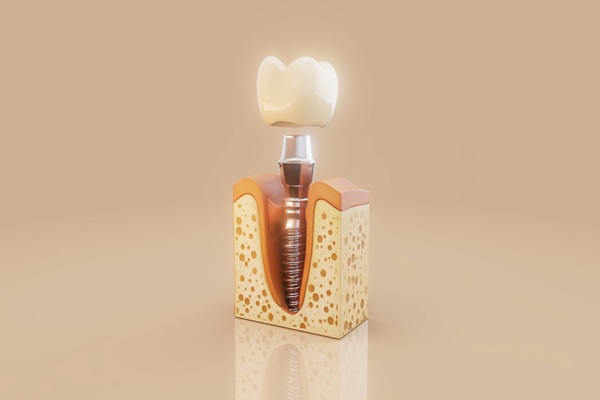How Dental Implants Slow Down And Prevent Bone Loss