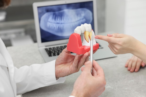 Dental Implants To Replace Missing Teeth