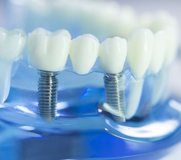 Bakersfield Dental Implants