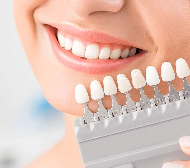 Bakersfield Dental Veneers and Dental Laminates