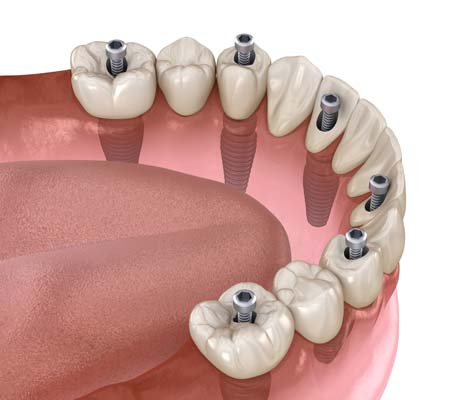 Implant Supported Dentures Bakersfield, CA