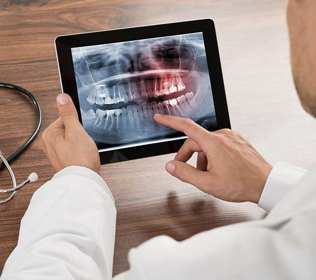 Bakersfield Types of Dental Root Fractures